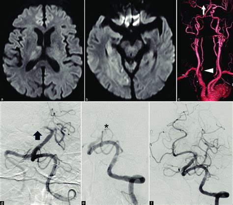 A C Magnetic Resonance Imaging On Admission Revealed Acute Cerebral