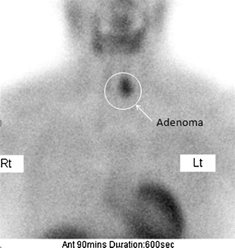 Parathyroid Imaging And Localization Using Spectct Initial Results