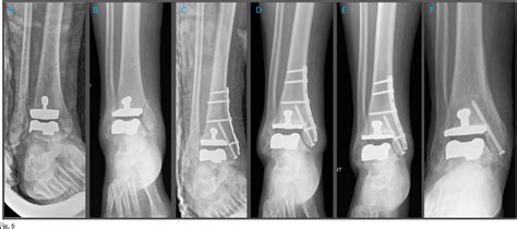 Figure 1 From Salto Talaris Total Ankle Arthroplasty Clinical Results