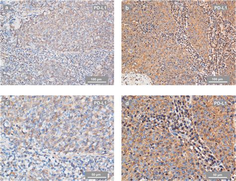 Representative Ihc Staining Of Pd L In Npc Biopsies A C Pd L