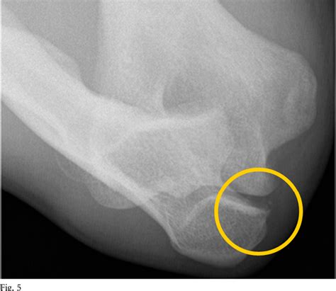 Figure 1 From Ulnar Collateral Ligament Reconstruction In Throwing Athletes A Review Of Current