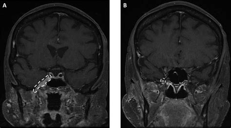 Magnetic Resonance Images Indicate Perineural Spread Of Head And Neck