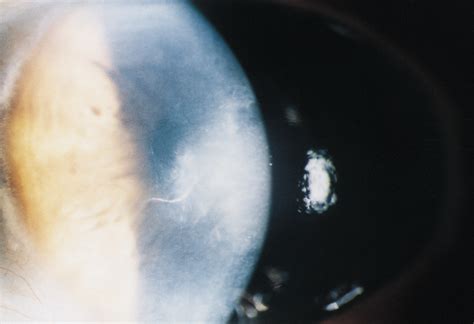 Bilateral Descemet Membrane Detachments Cataract And Other Lens Disorders Jama Ophthalmology