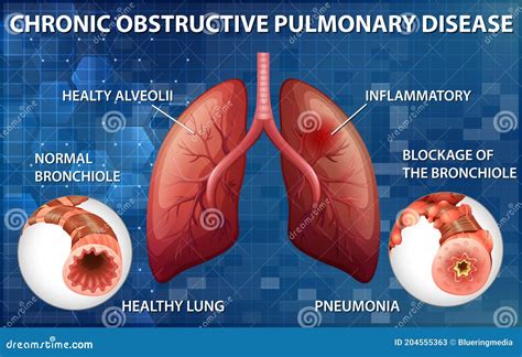 Chronic Obstructive Pulmonary Disease Stock Vector Illustration Of