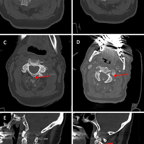 Computed Tomography Ct Scans Of The Cervical Spine At Admission A Download Scientific