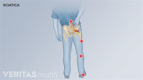 Types Of Sciatic Nerve Pain Spine Health