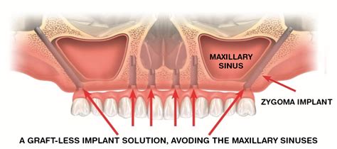 Zygoma Implants | FMS DENTAL HOSPITAL