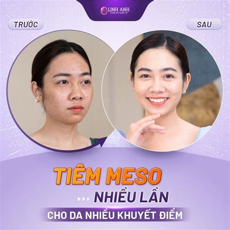 Tiêm Meso Giá Bao Nhiêu Tiền 1 Lần Bảng Giá Tiêm Meso 2024