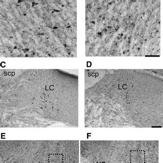 Tauopathy In Pontine Reticular Nucleus Locus Ceruleus And Raphe