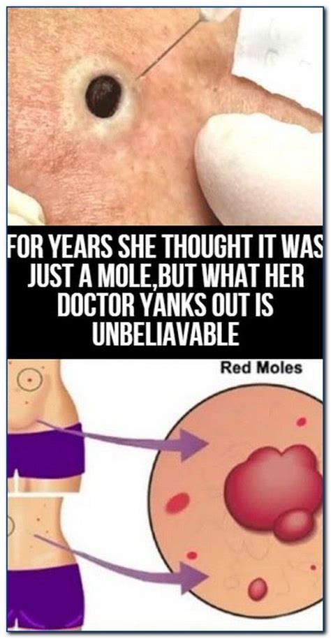 FOR YEARS SHE THOUGHT IT WAS JUST A MOLE BUT WHAT HER DOCTOR YANKS OUT