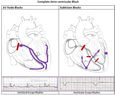 Two Types of Complete Heart Block | ECG Guru - Instructor Resources