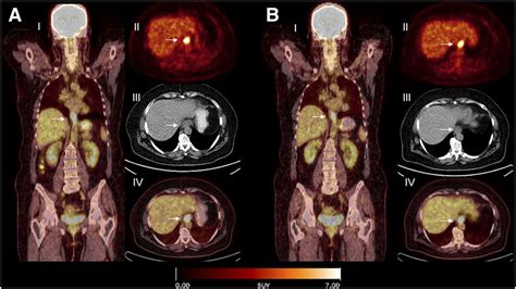 18F FDG PET And 18F FDG PET CT For Assessing Response To Therapy In