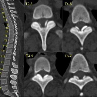 Sagittal (left) and axial (right) computed tomography cuts (T2-T7) of ...