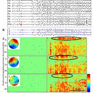 PDF Ictal EEG Source Localization In Focal Epilepsy Review And