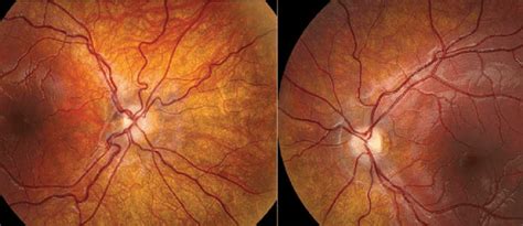 Optic Nerve Hypoplasia