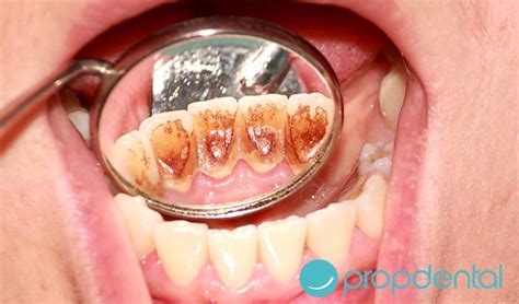 Lo Sabes Todo Sobre El Biofilm Dental Cl Nicas Propdental