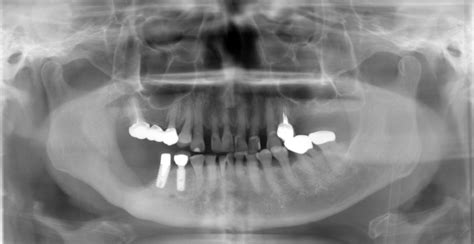 Osteoradionecrosis Of Jaw