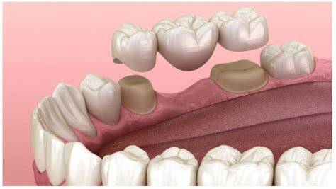 Enhancing Smiles With Dental Bridges In Orlando Fl Procedure