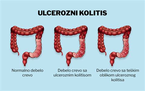Simptomi Na Rak Na Debelo Crevo Growthcenter Continental Edu Pe