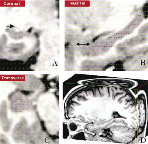 Hippocampal Volume Measurement Using Stereology A Coronal Section