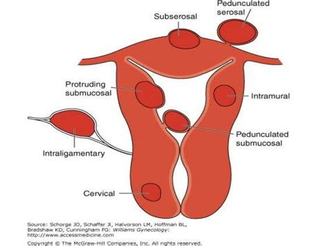 Pelvic Mass