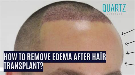 How To Remove Edema After Hair Transplant Quartz Hair