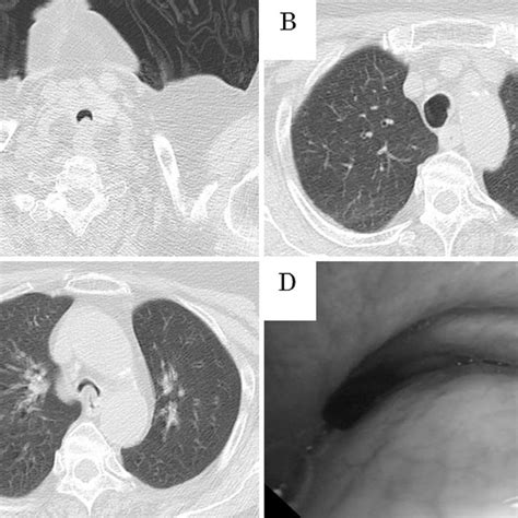 Figurect Of The Chest Showing Lower Tracheal Collapse A Ct Scan Of