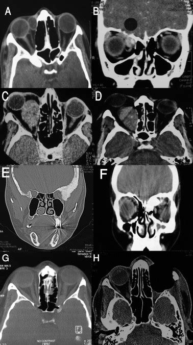 A Dermoid Cyst An Oval Cystic Extraconal Lesion Is Seen On Axial Ct