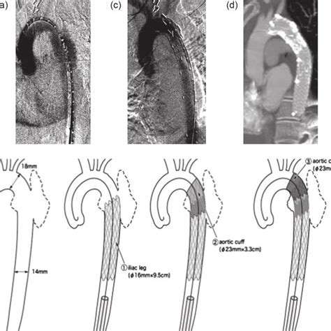 Aortogram, illustration of the procedure, and follow-up CT. (a ...