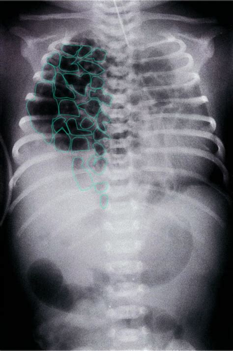 Diaphragmatic Hernia X Ray