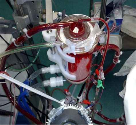 Extracorporeal Membrane Oxygenation Indications Technique And