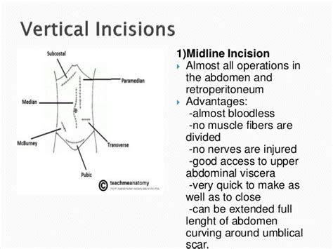 Surgical Incisions