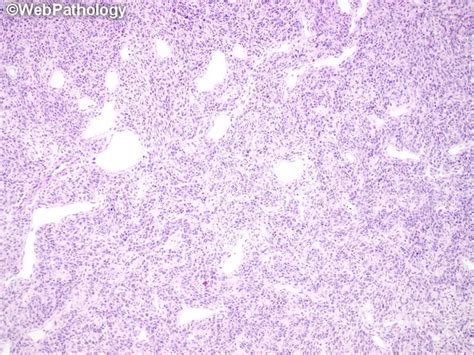 Synovial Sarcoma