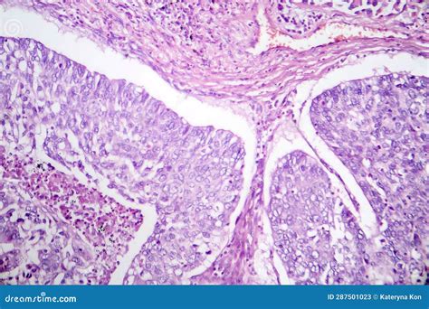 Lung Adenocarcinoma, Light Micrograph Stock Image - Image of histology ...