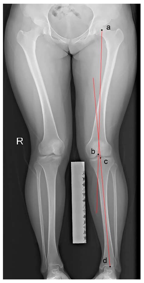 Medicina Free Full Text Femoral Anteversion Measured By The