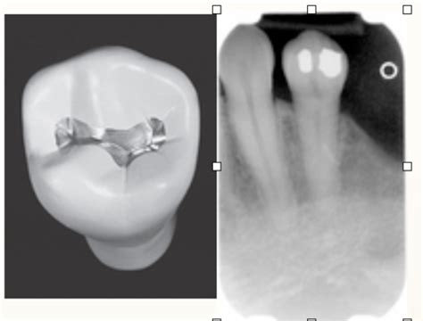 Chapter 32 Identification Of Restorations Dental Materials And