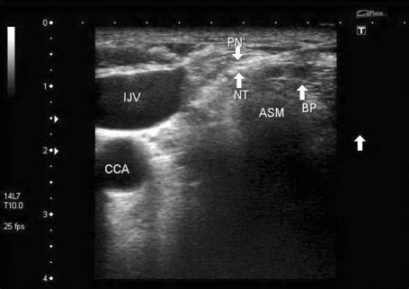 Ultrasound image of needle tip which is adjacent to phrenic nerve for ...