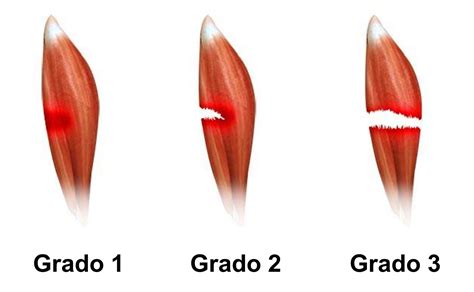 Roturas Tendinosas