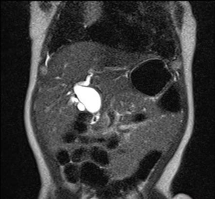 Choledochal Cyst Image Radiopaedia Org