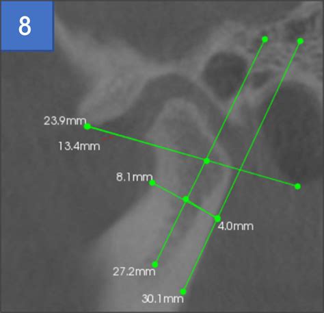 Correlation Of Cephalometric Measurements Of Tmj On Cbct And Mr Images