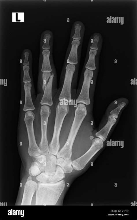 Xray Broken Finger