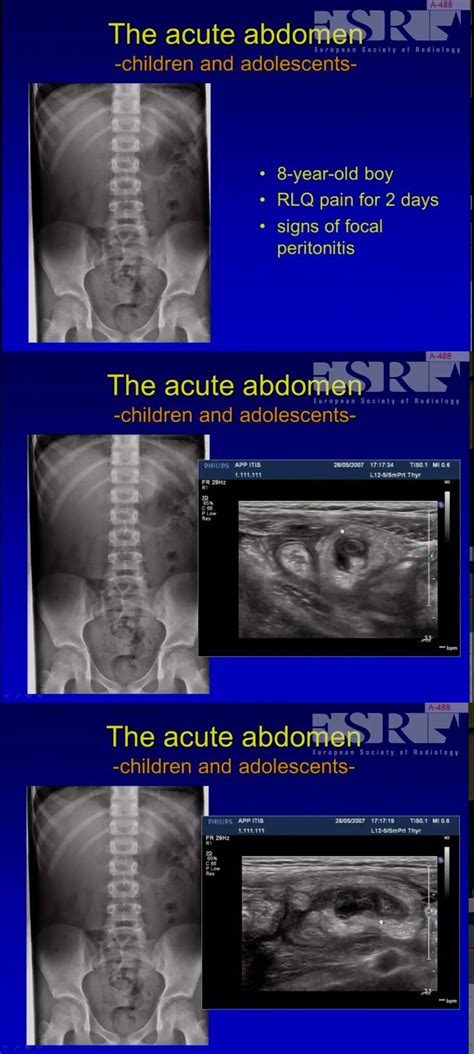 Ultrasound In Pediatric Abdomen Emergency Pediatrics Abdomen Ultrasound