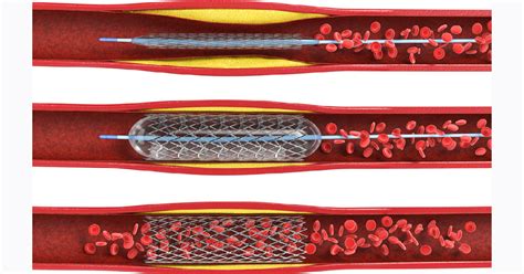 Coronary Angioplasty: Indications, Procedure, Risk factors