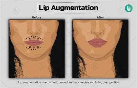 Lip Augmentation Procedure Purpose Results Cost Price Indications Recovery