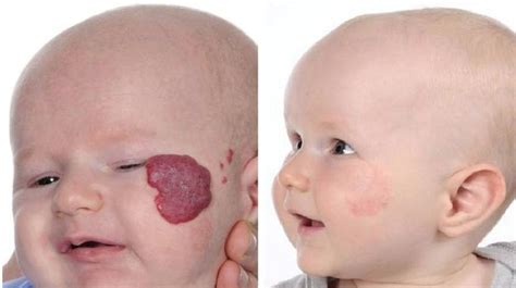 Cherry Hemangioma On The Face At Connie Williams Blog