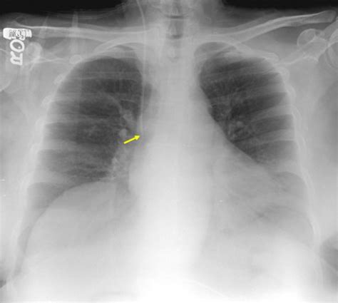 Different Radiographic Representation Of Hemothorax: It's Manifestation ...