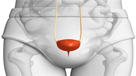 Bladder Stones: Symptoms and Treatment