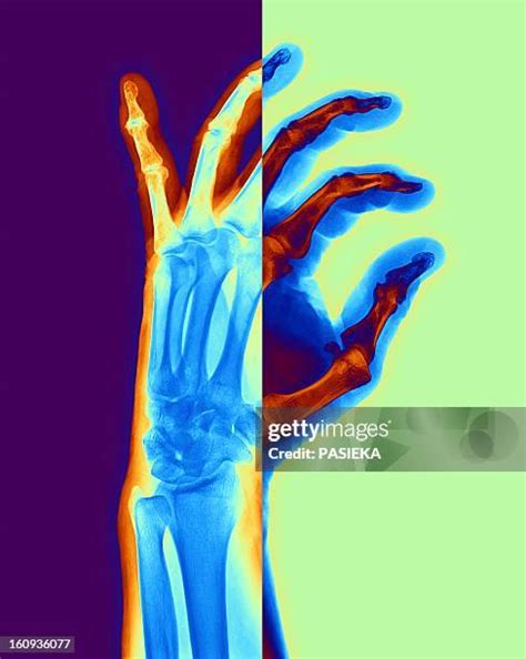 171 X Ray Of Arthritic Hand Stock Photos, High-Res Pictures, and Images ...