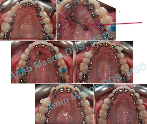 Temporary Anchorage Devices Columbus Polaris Orthodontic Center