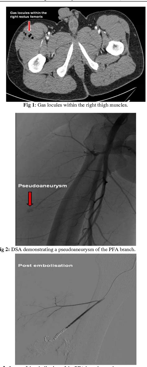 Figure 2 From Penetrating Thigh Trauma Resulting In The Profunda Femoris Artery Pseudoaneurysm